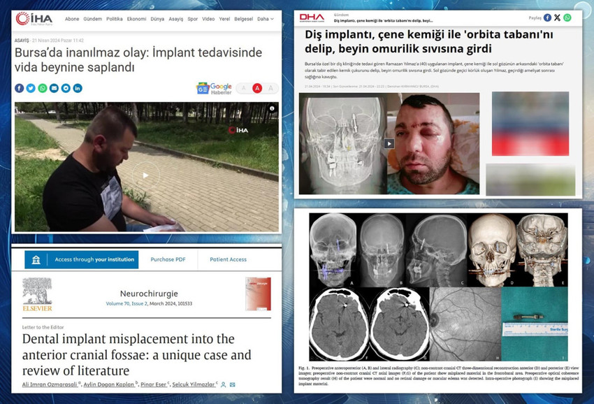 Implant vidası beyne saplanmadı - Resim : 1