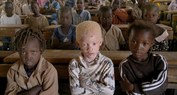 Albino çocuklar kemikleri için öldürüldü