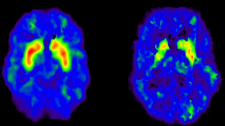 Alzheimer kaynaklı hafıza kaybını durduran ilaç