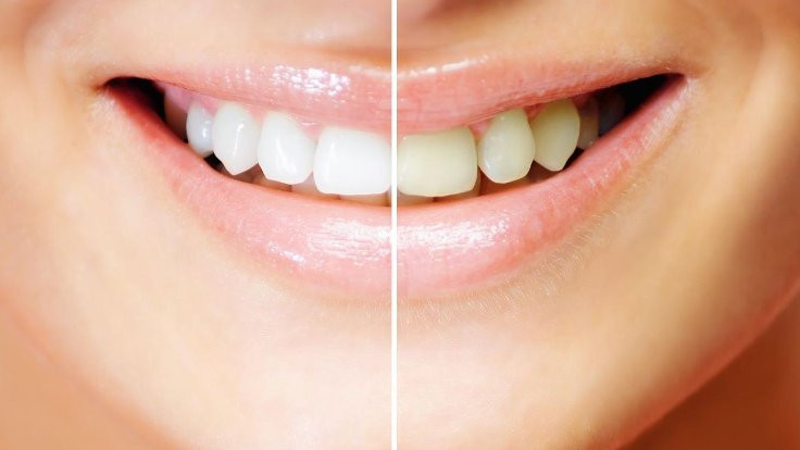 Dişleri beyazlatmanın 5 yolu