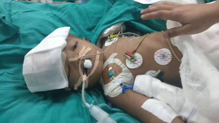 Hint cerrahlar, 16 saatlik ameliyat sonrası yapışık ikizleri ayırdı
