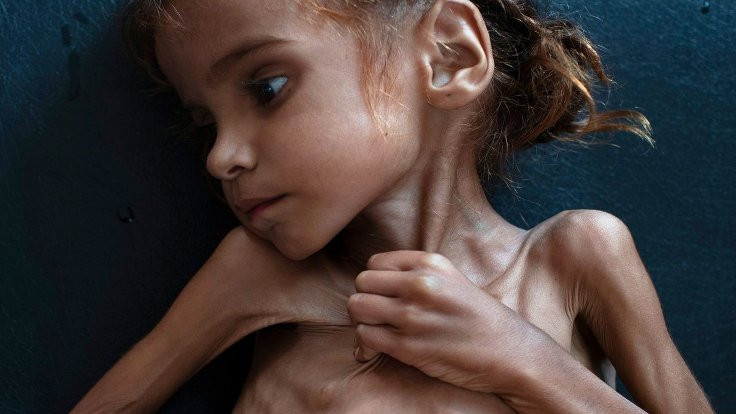 Yemen'deki savaşın 7 yaşındaki sembolü Emel hayatını kaybetti
