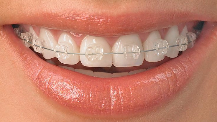 İmplant Uygulama Şekli ve Diş Teli Takımı Hakkında Bilgi