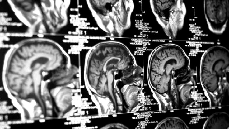 Beyin rahatsızlıkları için implant geliştirildi