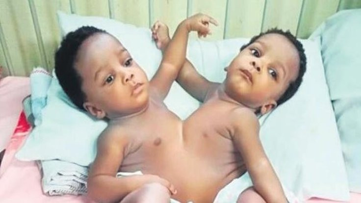 Siyam ikizlerini 78 doktor ayırdı