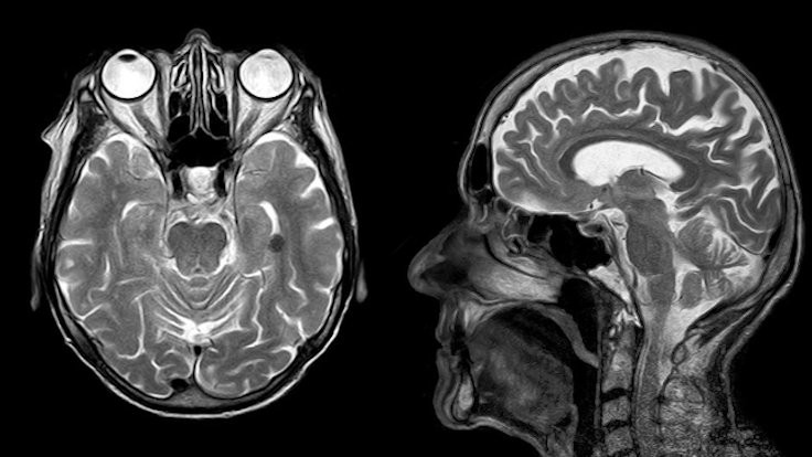 Covid-19 kalıcı beyin hasarına neden oluyor