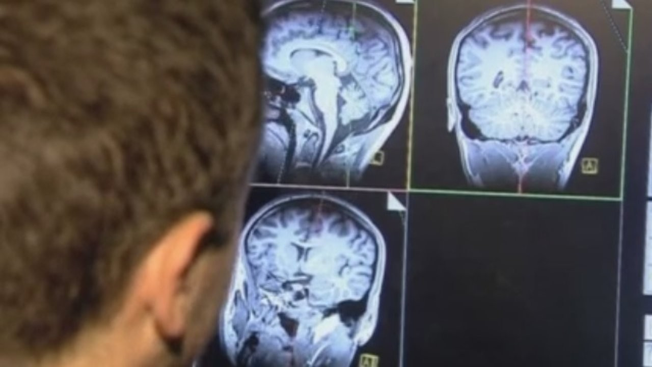 Kanada'da gizemli beyin hastalığı doktorları afallattı