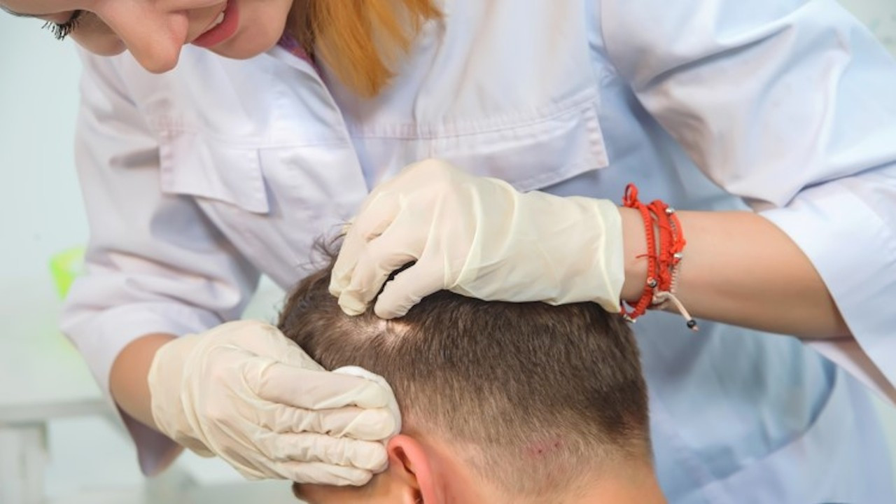 İddia: Saç ekim merkezlerinin yarısı doktorsuz işlem yapıyor