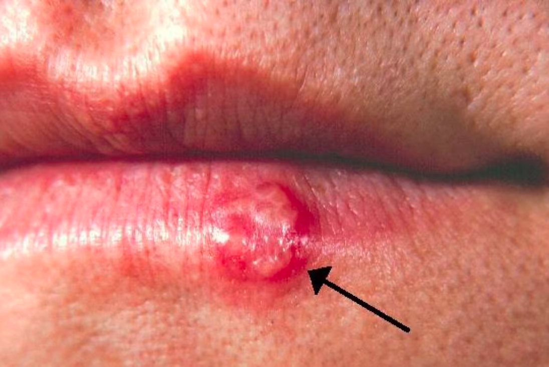 Araştırma: Uçuk virüsü Bronz Çağı'ndaki öpüşme geleneğinin mirası - Sayfa 1