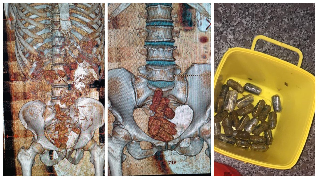 Bağırsaklarındaki uyuşturucu tomografiyle ortaya çıktı