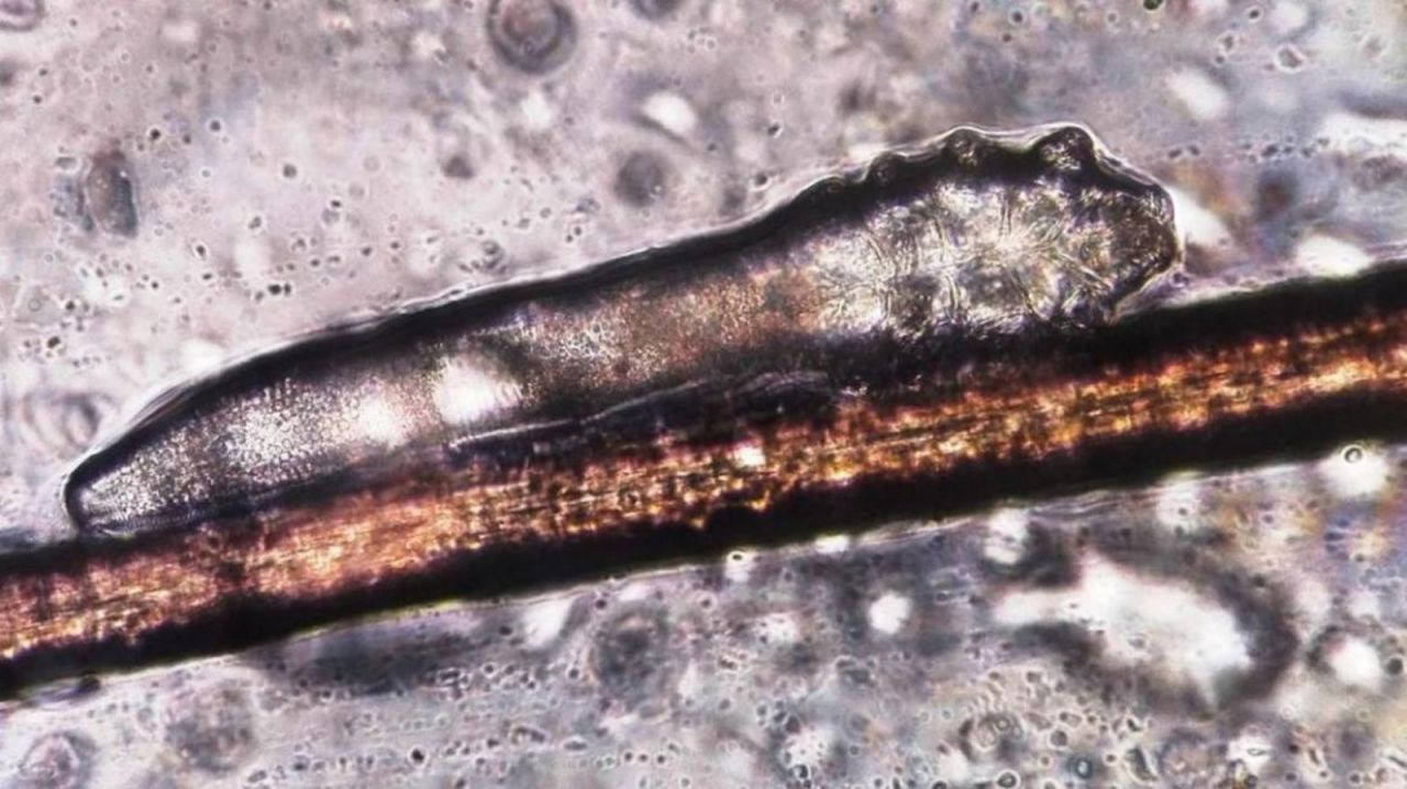 İnsan derisinde 2,5 milyon tane yaşıyor: Temasla bulaşan mikroskobik akar - Sayfa 4