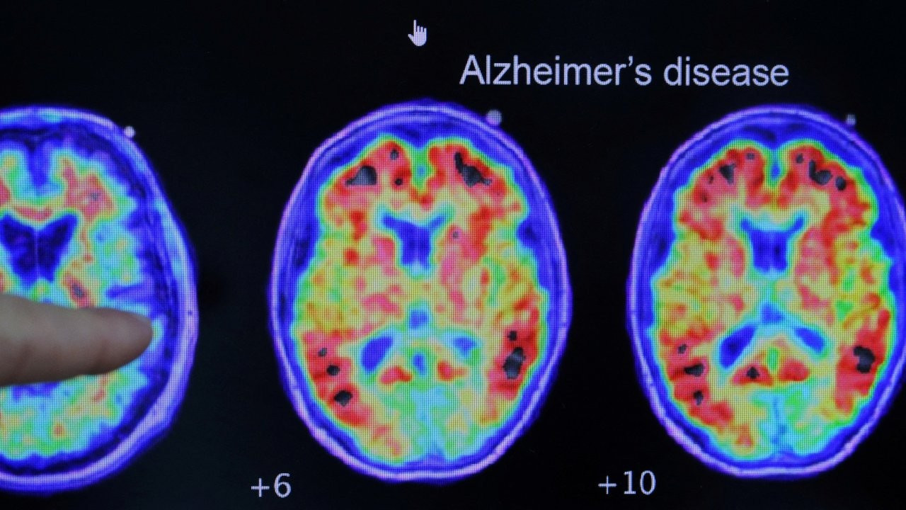 Alzheimer ilacı piyasaya sunulacak: 'Hastalar sıraya giriyor'