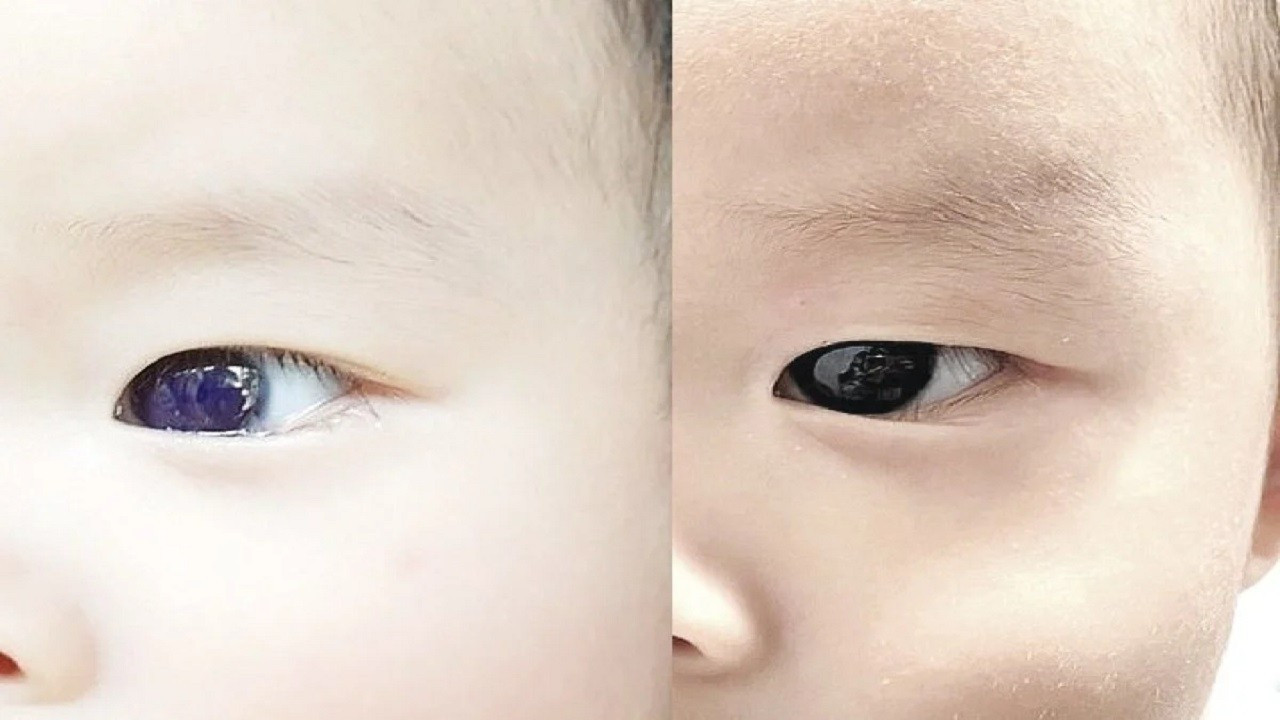 Covid hastası bebeğin göz rengi değişti