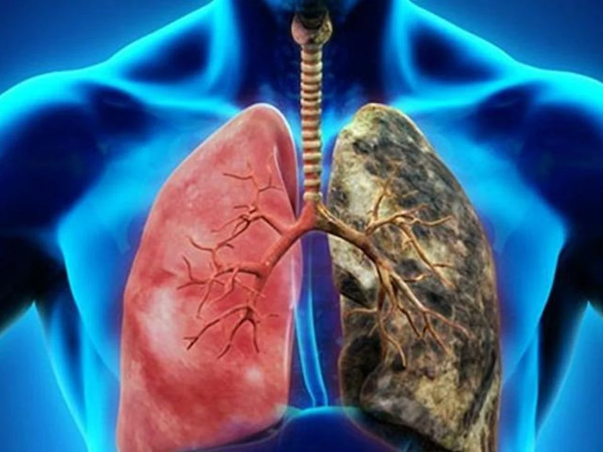 Akciğerlerinizin son durumunu ele veren 4 sinyal - Sayfa 3