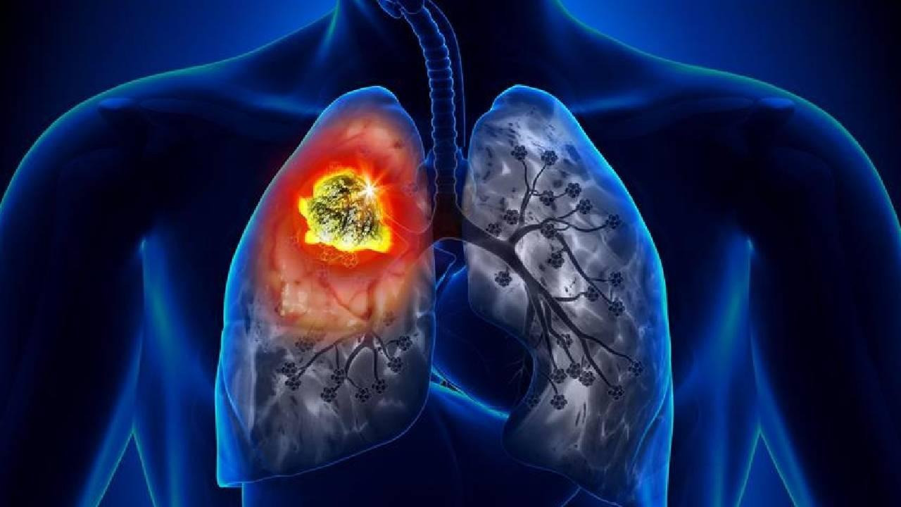 Akciğer kanserinin 10 önemli sinyali: İnatçı öksürük de alarm olabilir