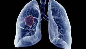 Akciğer kanserinin belirtilerine dikkat: Yılda 41 bin kişi... - Sayfa 1