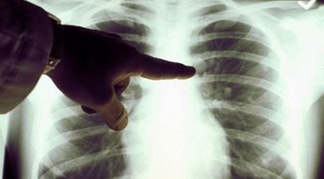 Akciğer kanserinin belirtilerine dikkat: Yılda 41 bin kişi... - Sayfa 4