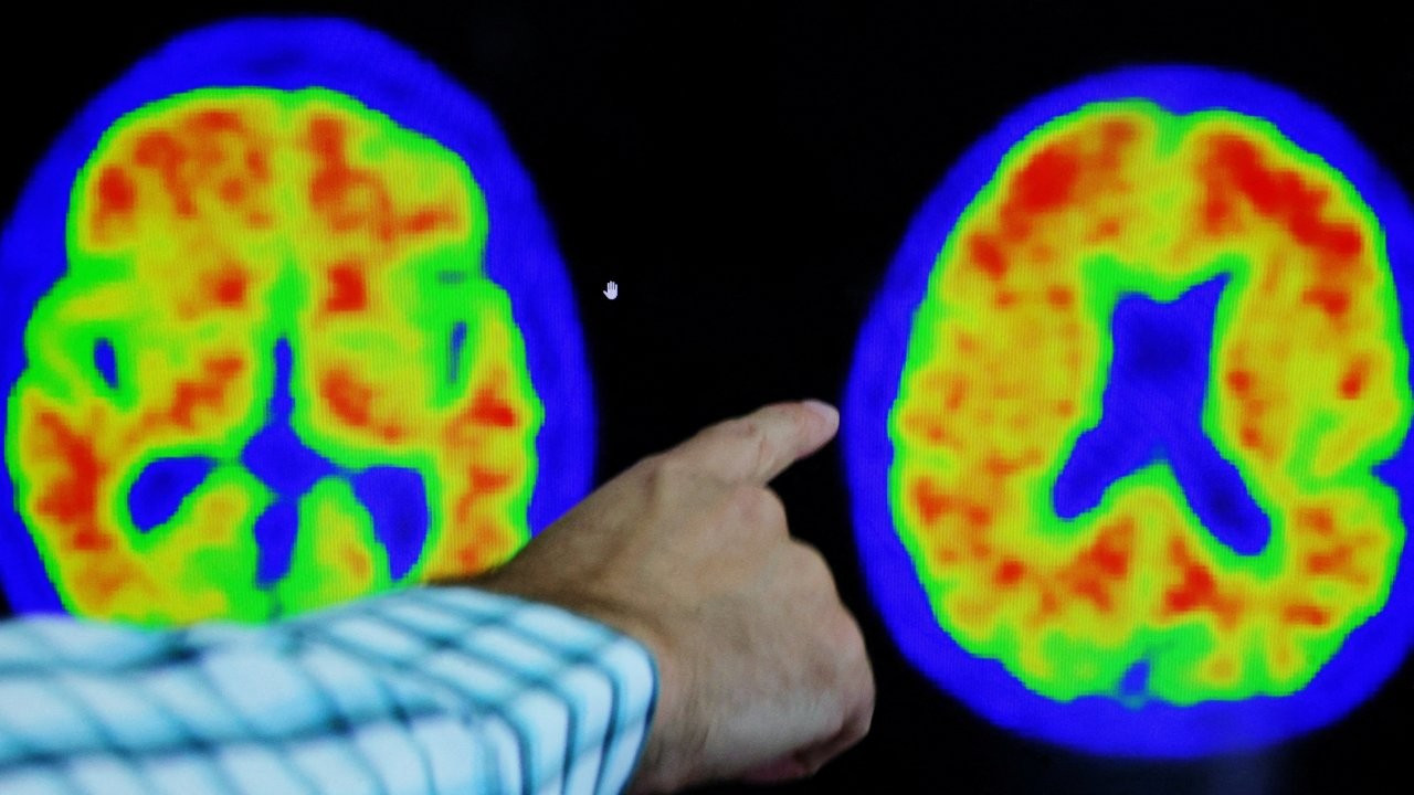 Uçuk virüsleri Alzheimer'ı mi tetikliyor?