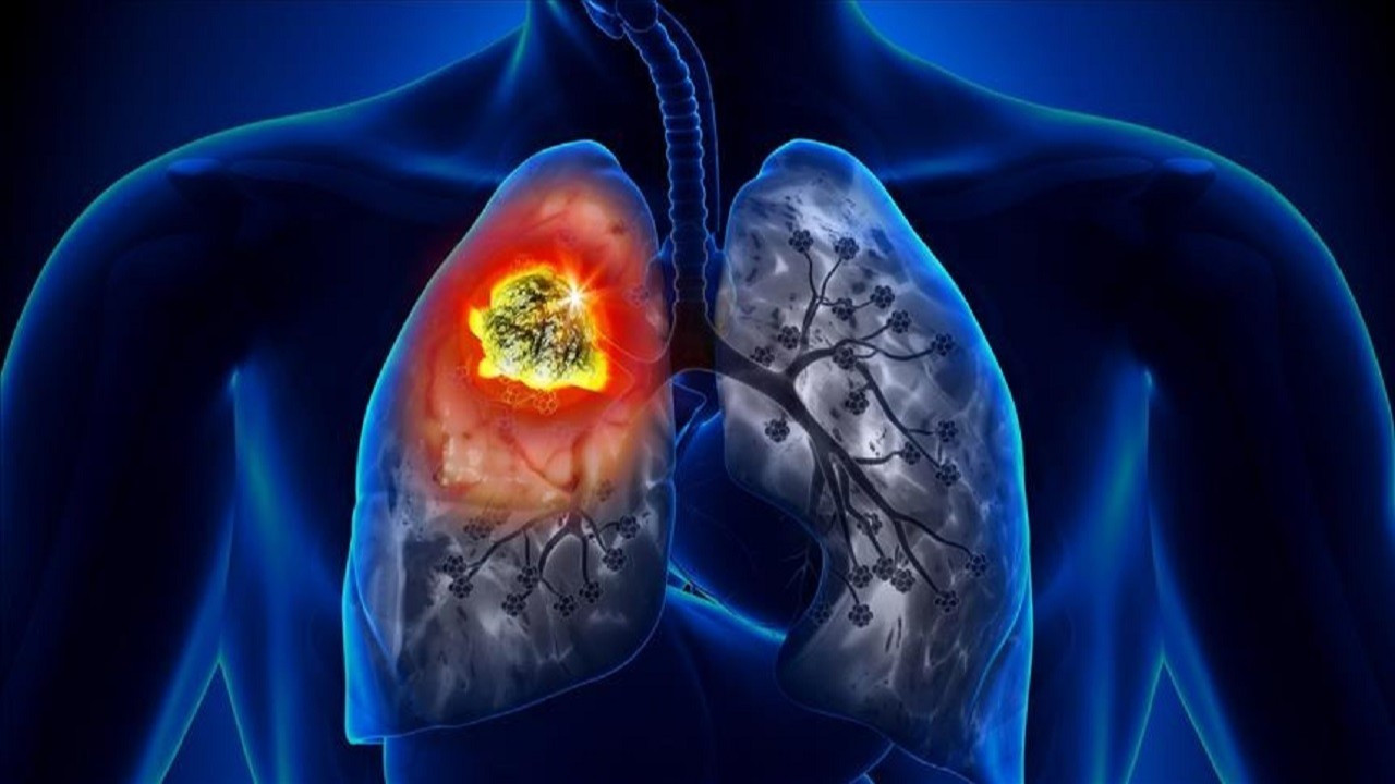 'Sigara içenlerde akciğer kanseri riski 15-30 kat fazla'